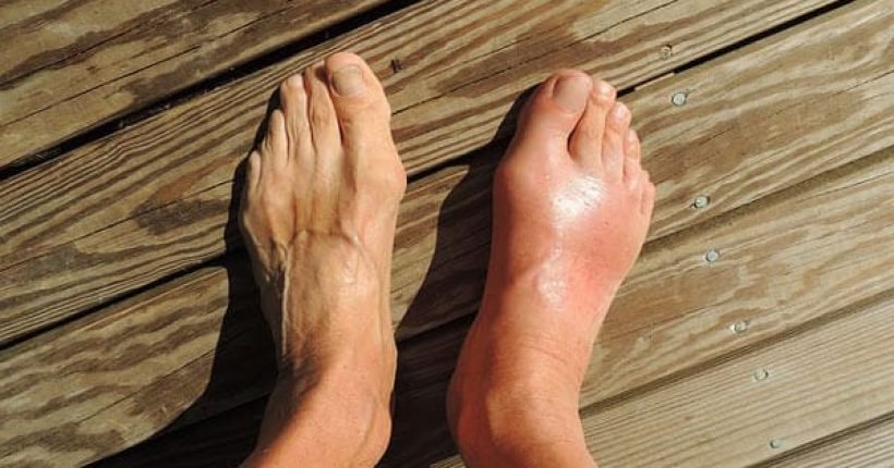 gout